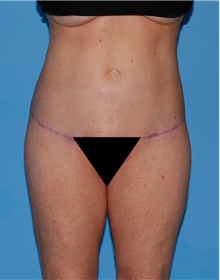 Body Contouring After Photo by Siamak Agha, MD; Newport Beach, CA - Case 44094