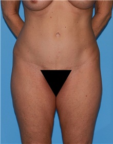 Body Contouring Before Photo by Siamak Agha, MD; Newport Beach, CA - Case 44094