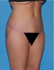 Body Contouring After Photo by Siamak Agha, MD PhD FACS; Newport Beach, CA - Case 44094