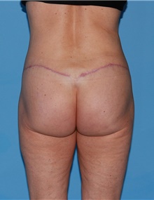 Body Contouring After Photo by Siamak Agha, MD PhD FACS; Newport Beach, CA - Case 44094