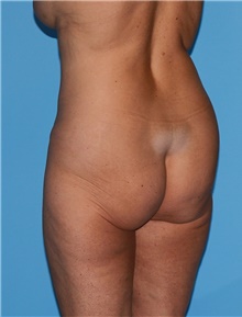 Body Contouring Before Photo by Siamak Agha, MD PhD FACS; Newport Beach, CA - Case 44094