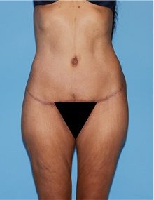 Body Contouring After Photo by Siamak Agha, MD PhD FACS; Newport Beach, CA - Case 44095