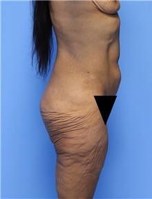 Body Contouring Before Photo by Siamak Agha, MD PhD FACS; Newport Beach, CA - Case 44095