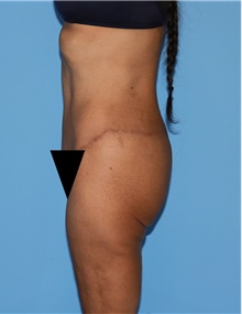 Body Contouring After Photo by Siamak Agha, MD PhD FACS; Newport Beach, CA - Case 44095