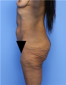 Body Contouring Before Photo by Siamak Agha, MD PhD FACS; Newport Beach, CA - Case 44095