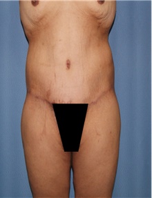 Body Contouring After Photo by Siamak Agha, MD; Newport Beach, CA - Case 44096