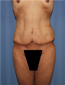 Body Contouring Before Photo by Siamak Agha, MD; Newport Beach, CA - Case 44096