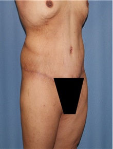 Body Contouring After Photo by Siamak Agha, MD PhD FACS; Newport Beach, CA - Case 44096