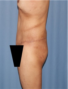 Body Contouring After Photo by Siamak Agha, MD PhD FACS; Newport Beach, CA - Case 44096