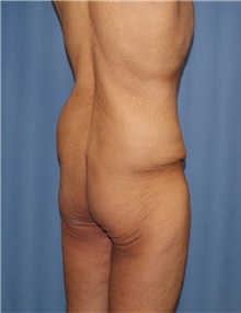 Body Contouring Before Photo by Siamak Agha, MD PhD FACS; Newport Beach, CA - Case 44096