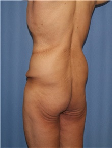 Body Contouring Before Photo by Siamak Agha, MD PhD FACS; Newport Beach, CA - Case 44096