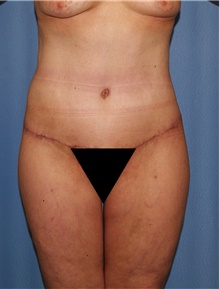 Body Contouring After Photo by Siamak Agha, MD; Newport Beach, CA - Case 44097
