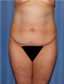 Body Contouring Before Photo by Siamak Agha, MD; Newport Beach, CA - Case 44097