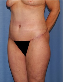 Body Contouring After Photo by Siamak Agha, MD PhD FACS; Newport Beach, CA - Case 44097