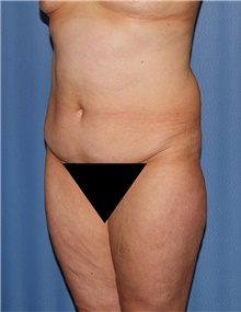 Body Contouring Before Photo by Siamak Agha, MD PhD FACS; Newport Beach, CA - Case 44097