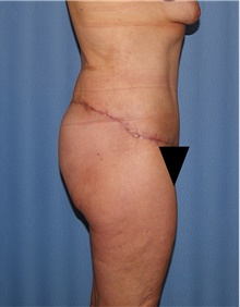 Body Contouring After Photo by Siamak Agha, MD PhD FACS; Newport Beach, CA - Case 44097