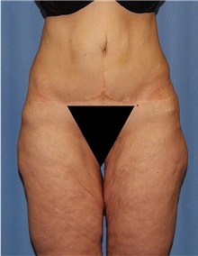Body Contouring Before Photo by Siamak Agha, MD PhD FACS; Newport Beach, CA - Case 44098