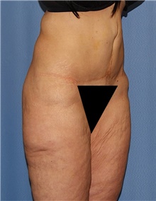 Body Contouring Before Photo by Siamak Agha, MD PhD FACS; Newport Beach, CA - Case 44098