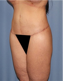 Body Contouring After Photo by Siamak Agha, MD PhD FACS; Newport Beach, CA - Case 44098