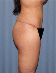 Body Contouring After Photo by Siamak Agha, MD PhD FACS; Newport Beach, CA - Case 44098
