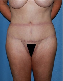 Body Contouring After Photo by Siamak Agha, MD PhD FACS; Newport Beach, CA - Case 44101