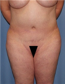 Body Contouring Before Photo by Siamak Agha, MD PhD FACS; Newport Beach, CA - Case 44101