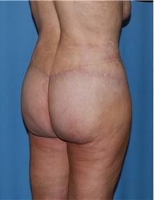 Body Contouring After Photo by Siamak Agha, MD PhD FACS; Newport Beach, CA - Case 44101