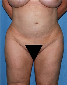 Body Contouring Before Photo by Siamak Agha, MD PhD FACS; Newport Beach, CA - Case 44102