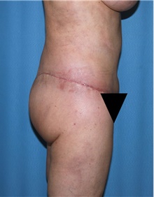 Body Contouring After Photo by Siamak Agha, MD PhD FACS; Newport Beach, CA - Case 44102