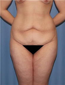 Body Contouring Before Photo by Siamak Agha, MD PhD FACS; Newport Beach, CA - Case 44103