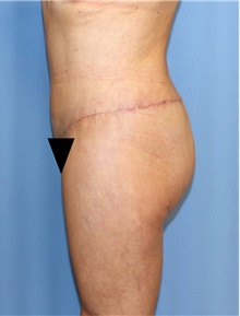 Body Contouring After Photo by Siamak Agha, MD PhD FACS; Newport Beach, CA - Case 44107