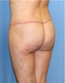 Body Contouring After Photo by Siamak Agha, MD PhD FACS; Newport Beach, CA - Case 44107