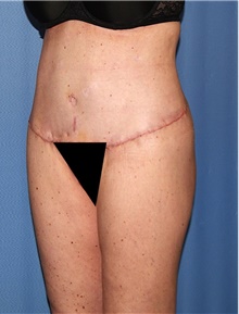 Body Contouring After Photo by Siamak Agha, MD PhD FACS; Newport Beach, CA - Case 44108