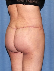Body Contouring After Photo by Siamak Agha, MD PhD FACS; Newport Beach, CA - Case 44108