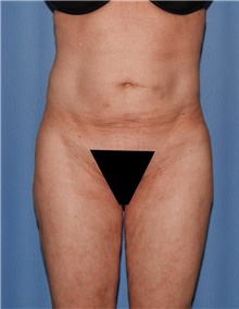 Body Contouring Before Photo by Siamak Agha, MD PhD FACS; Newport Beach, CA - Case 44109
