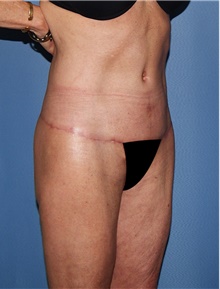 Body Contouring After Photo by Siamak Agha, MD PhD FACS; Newport Beach, CA - Case 44109