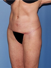 Body Contouring After Photo by Siamak Agha, MD PhD FACS; Newport Beach, CA - Case 44109