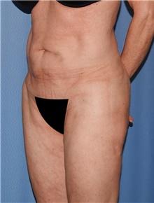 Body Contouring Before Photo by Siamak Agha, MD PhD FACS; Newport Beach, CA - Case 44109