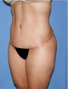 Body Contouring After Photo by Siamak Agha, MD PhD FACS; Newport Beach, CA - Case 44110