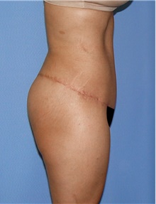 Body Contouring After Photo by Siamak Agha, MD PhD FACS; Newport Beach, CA - Case 44110