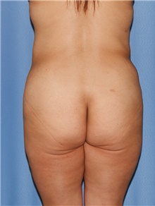 Body Contouring Before Photo by Siamak Agha, MD PhD FACS; Newport Beach, CA - Case 44110