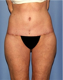 Body Contouring After Photo by Siamak Agha, MD PhD FACS; Newport Beach, CA - Case 44111