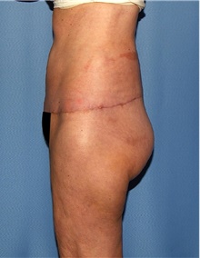 Body Contouring After Photo by Siamak Agha, MD PhD FACS; Newport Beach, CA - Case 44111