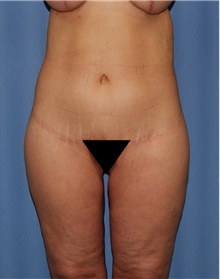 Body Contouring After Photo by Siamak Agha, MD; Newport Beach, CA - Case 44112