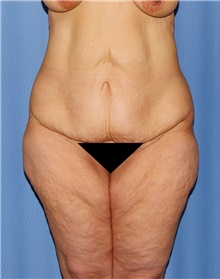 Body Contouring Before Photo by Siamak Agha, MD; Newport Beach, CA - Case 44112