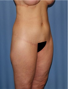 Body Contouring After Photo by Siamak Agha, MD PhD FACS; Newport Beach, CA - Case 44112