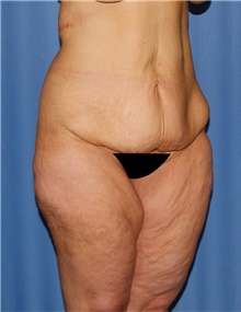 Body Contouring Before Photo by Siamak Agha, MD PhD FACS; Newport Beach, CA - Case 44112