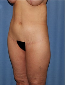 Body Contouring After Photo by Siamak Agha, MD PhD FACS; Newport Beach, CA - Case 44112