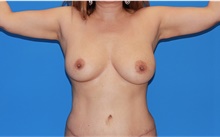 Arm Lift After Photo by Siamak Agha, MD; Newport Beach, CA - Case 44115