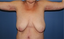 Arm Lift After Photo by Siamak Agha, MD; Newport Beach, CA - Case 44120